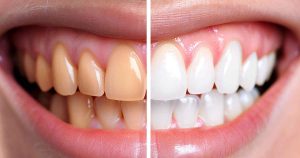 تصویر نمونه کامپوزیت