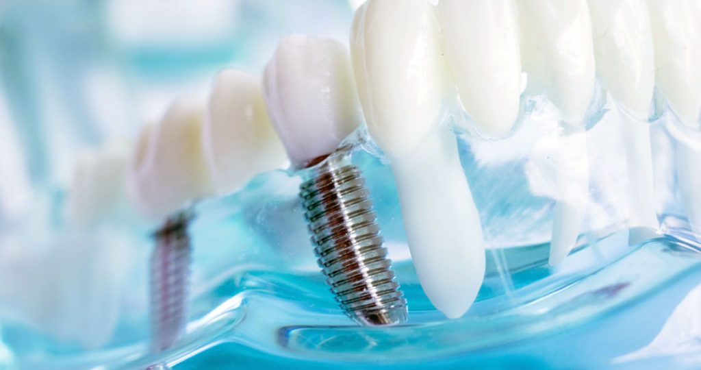 تصویر نمونه ایمپلنت