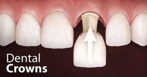 تصویر روکش دندان